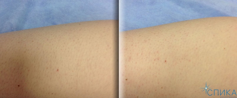 Лазерная эпиляция волос в Санкт-Петербурге | Цена эпиляции лазером ...