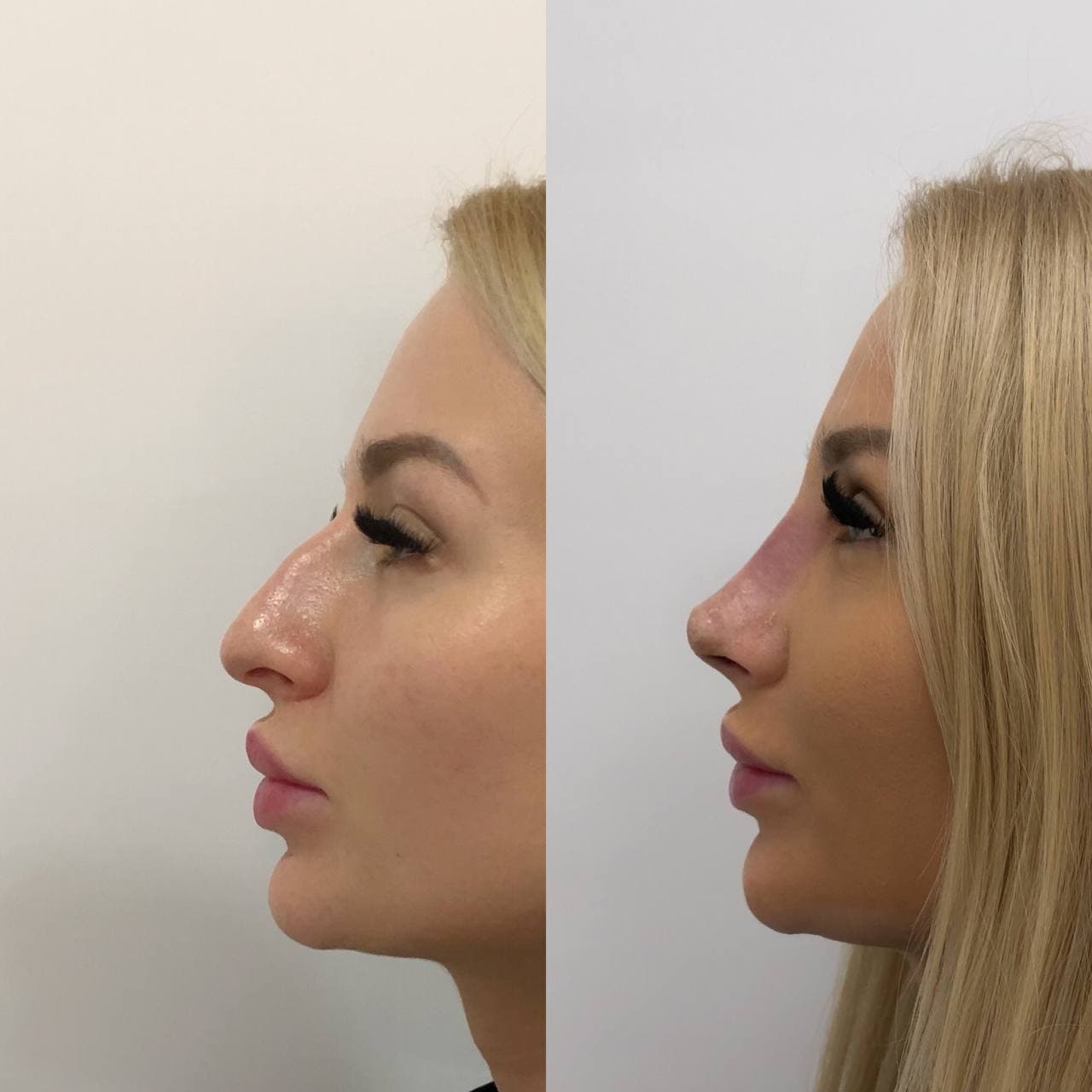 Фронтопластика. Пластическая операция на нос. Ринопластика до и после.